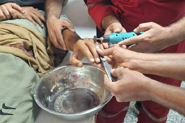رهاسازی انگشتر از دست مصدوم در بیمارستان جاسک